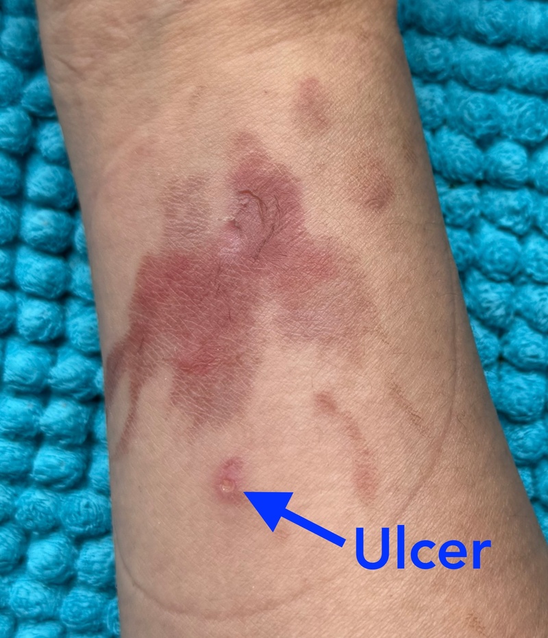2mm ulceration on a forearm with a healing splash burn wound