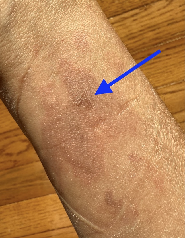 an irregular 3cm x 3cm erythematous splash burn wound first and second degree on right ventral wrist