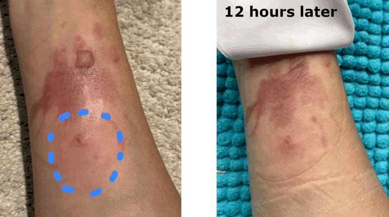 animation which shows the edges of a skin infection and how it appeared 12 hours after treatment