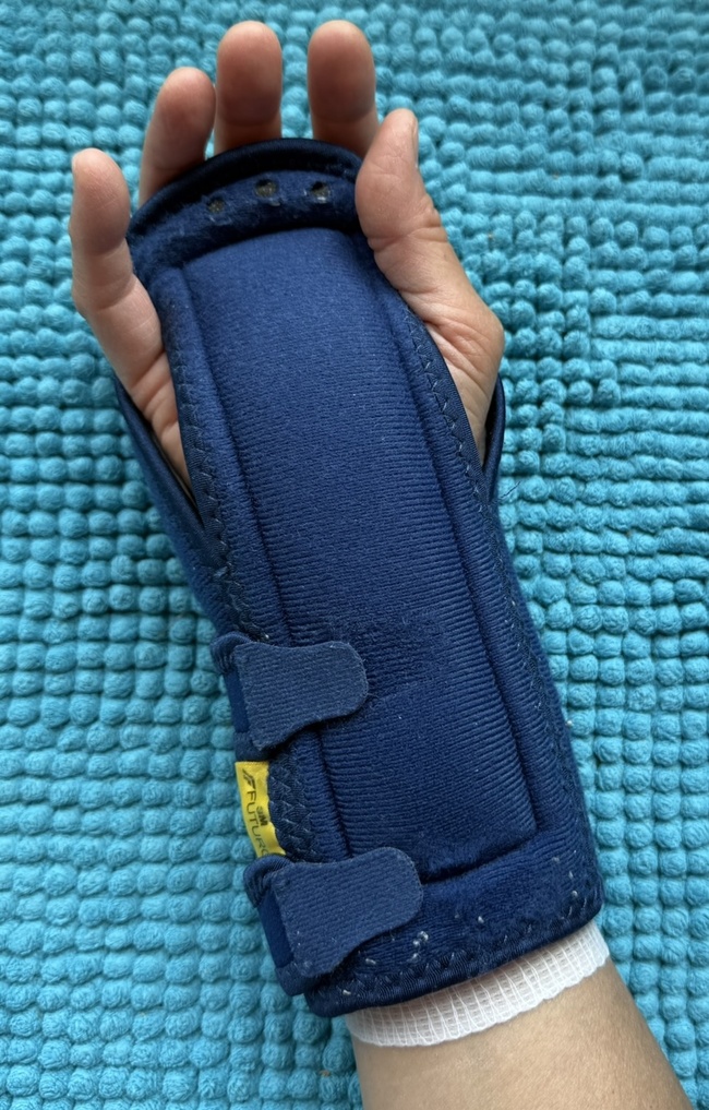 carpal tunnel nighttime wrist brace worn over a burn dressing