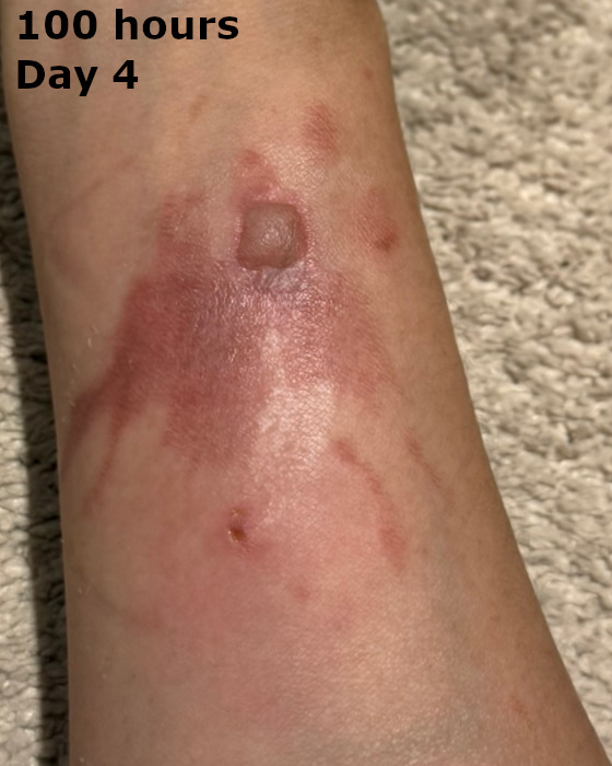cooking burn on forearm at one hundred hours
