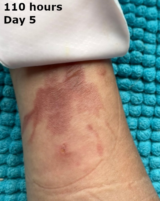 cooking burn at one hundred ten hours