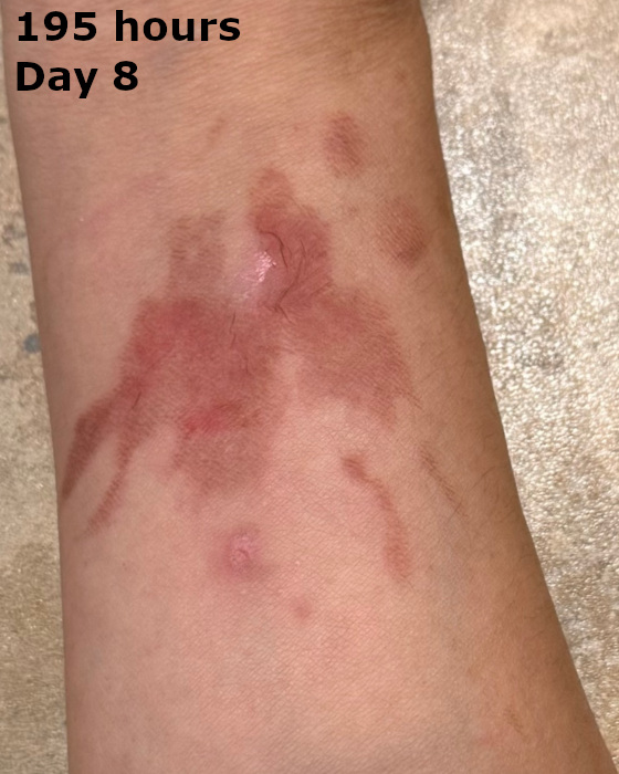 cooking burn on arm at one hundred ninety-five hours