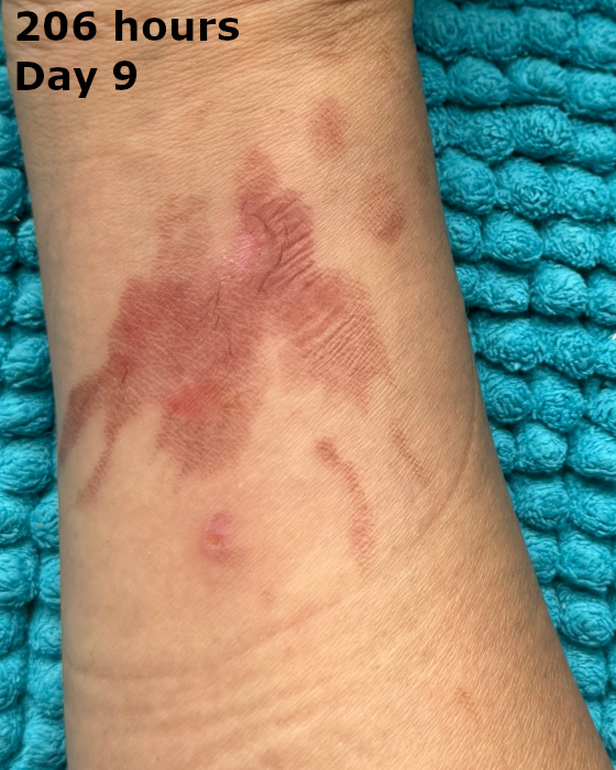 cooking burn on arm at two hundred six hours