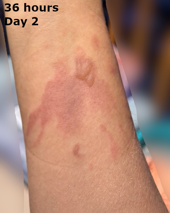 cooking burn on arm at thirty-six hours