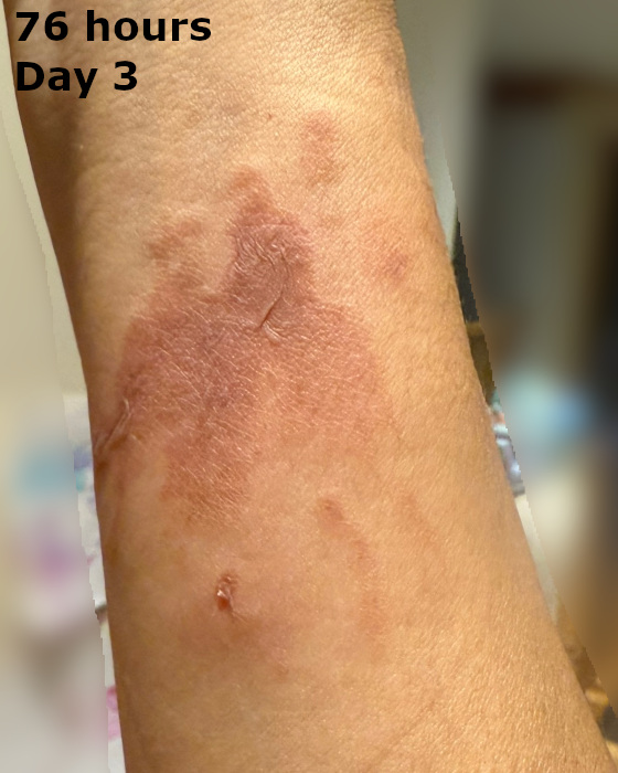 cooking burn on forearm at seventy-six hours