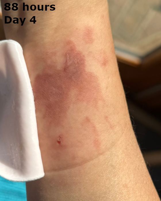 cooking burn on forearm at eighty-eight hours