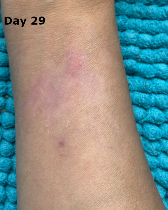 cooking burn on forearm at day 29