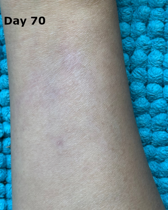 cooking burn on forearm at day 70