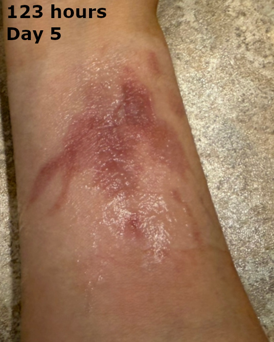 cooking burn on arm at one hundred twenty-three hours