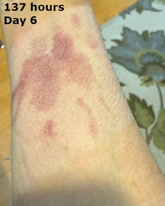 cooking burn on arm at one hundred thirty-seven hours