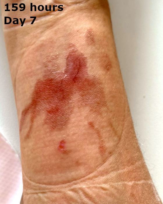 cooking burn on forearm at one hundred fifty-nine hours