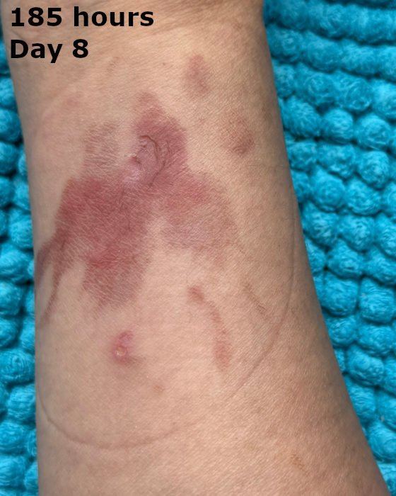 cooking burn on arm at one hundred eighty-five hours