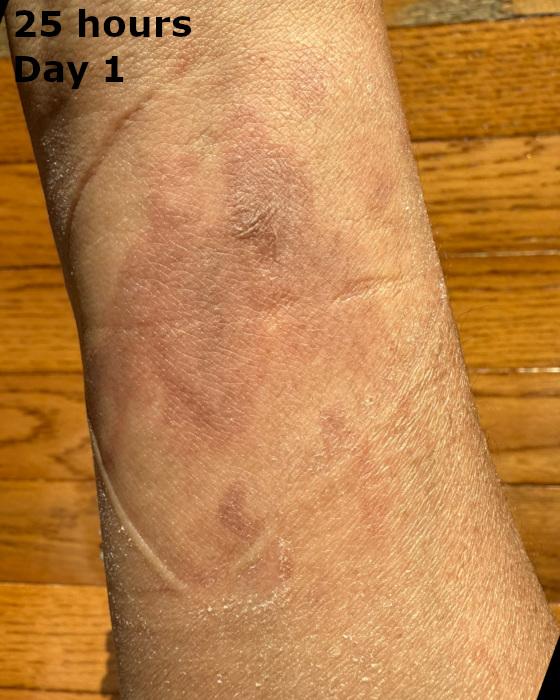 cooking burn on forearm at twenty-five hours