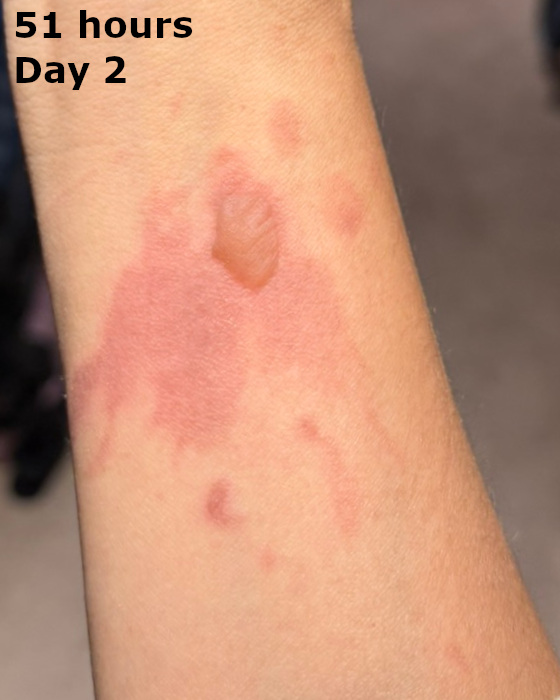 cooking burn on forearm at fifty-one hours
