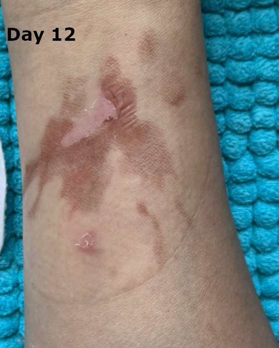 cooking burn on arm at day 12