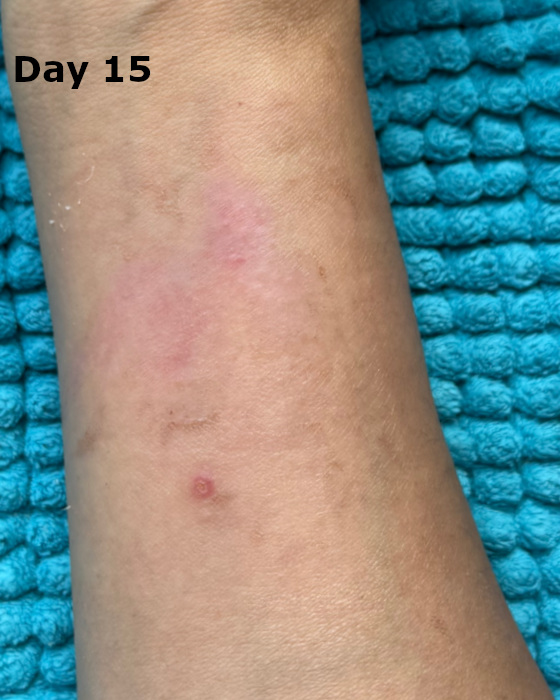 cooking burn on forearm at day 15