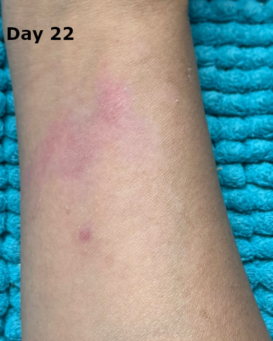 cooking burn on forearm at day 22