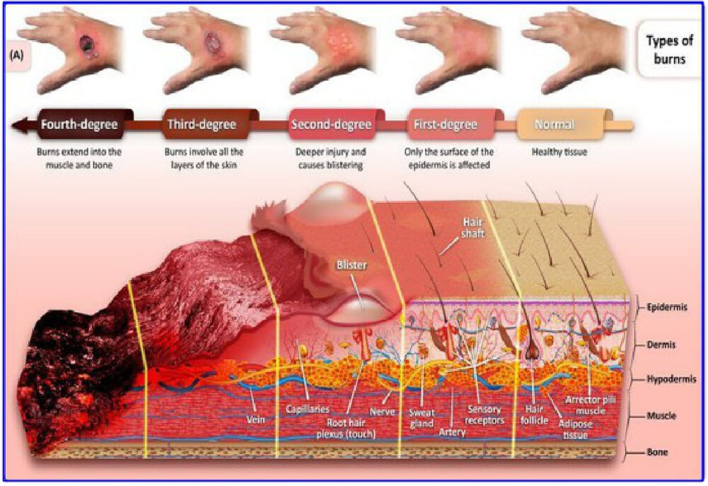 cross section of skin and visuals for first to fourth degree burns