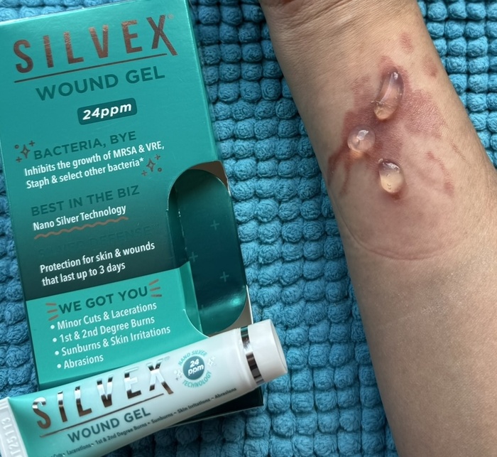 globs of antimicrobial silvex gel on a burn wound