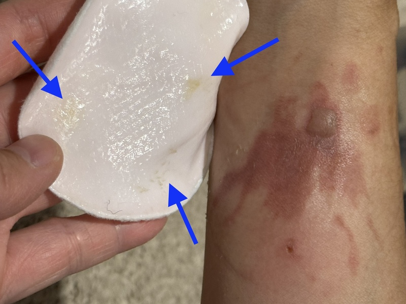 three areas of yellow exudate on hydrogel opposing the skin wounds that made them